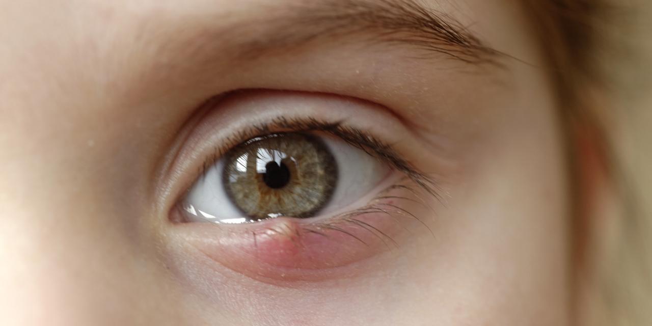 Close-up of a child's eye stye. Ophthalmic hordeolum disease