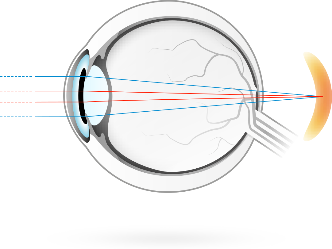 Farsightedness – condition in which visual images come to a focus behind the retina making it more difficult for the eyes to focus on near objects
