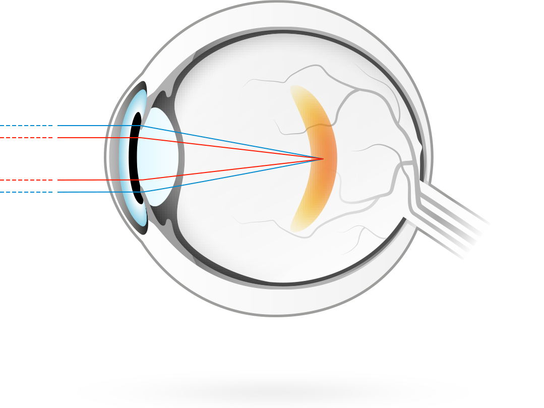 Nearsightedness – condition in which visual images come to a focus in front of the retina, causing blurry distance vision